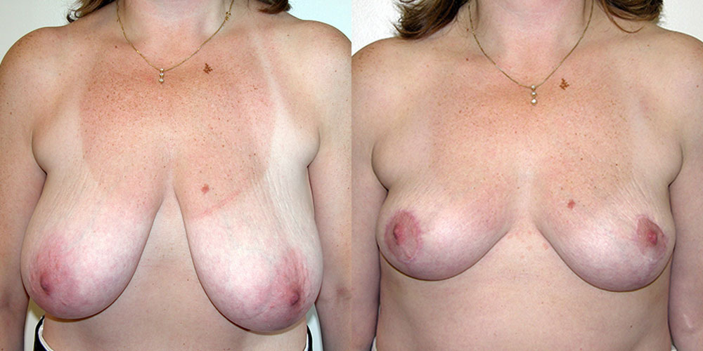 Breast reduction before and after patient