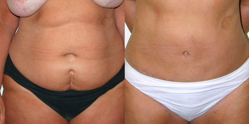 Body contouring before and after patient