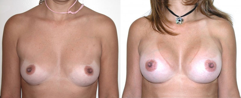 female patient before and after breast revision surgery