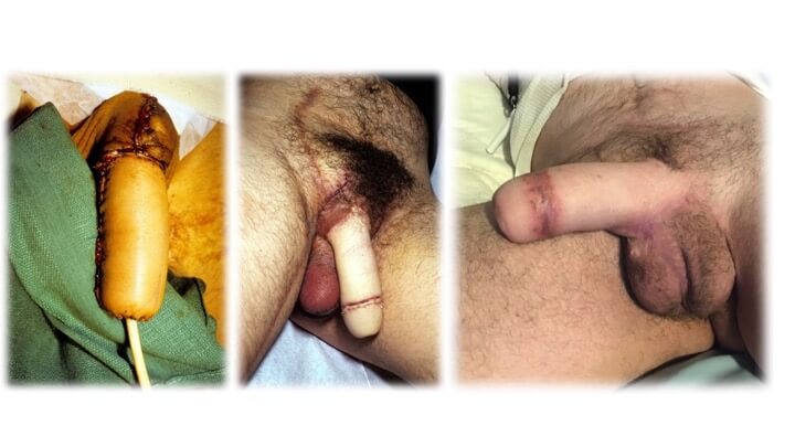 post op of the penis in various stages of healing. 