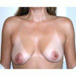 Breast Augmentation 2 Before Photo - 12