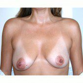 Breast Augmentation 2
