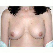 Breast Augmentation 1