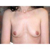 Breast Augmentation 1