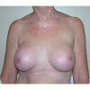 Breast Augmentation 3 After Photo Thumbnail