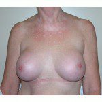 Breast Augmentation 3 After Photo - 1