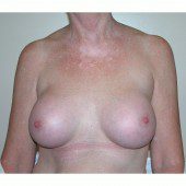 Breast Augmentation 3