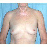 Breast Augmentation 3 Before Photo - 4