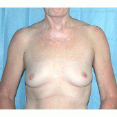 Breast Augmentation 3