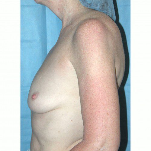 Breast Augmentation 3 Before Photo