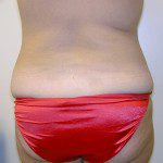 Liposuction 2 Before Photo - 5