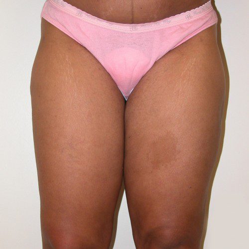 Liposuction 3 After Photo 