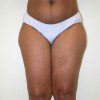 Liposuction 3 Before Photo Thumbnail