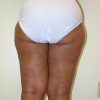 Liposuction 3 Before Photo Thumbnail