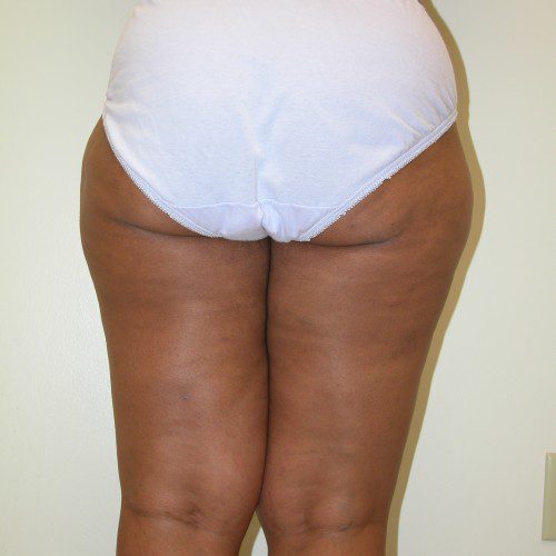 Liposuction 3 Before Photo