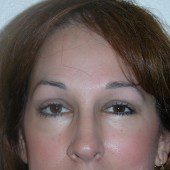 Blepharoplasty 2