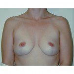 Breast Augmentation 25 Before Photo - 2