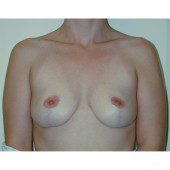 Breast Augmentation 25