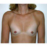 Breast Augmentation 26 Before Photo - 4