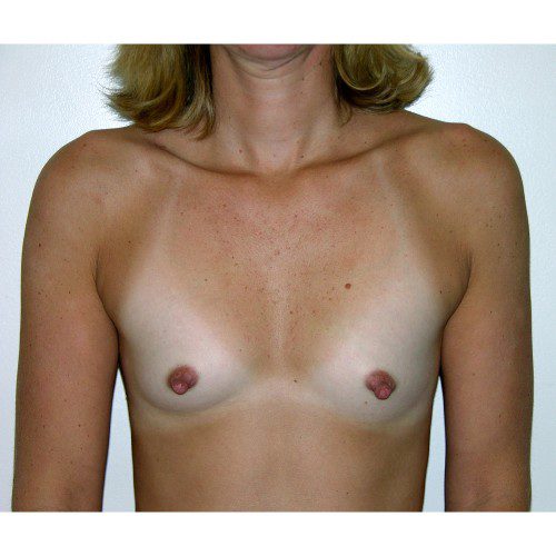 Breast Augmentation 26 Before Photo 