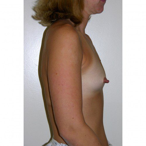 Breast Augmentation 26 Before Photo