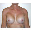 Breast Augmentation 28 After Photo Thumbnail