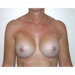 Breast Augmentation 28 After Photo - 2
