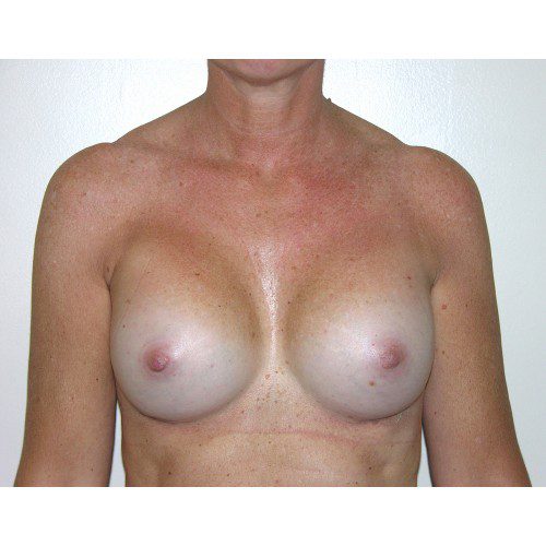 Breast Augmentation 28 After Photo 