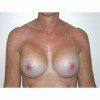 Breast Augmentation 4 After Photo Thumbnail