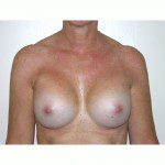 Breast Augmentation 4 After Photo - 11