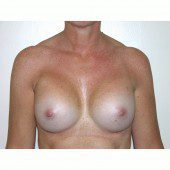 Breast Augmentation 4