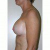 Breast Augmentation 4 After Photo Thumbnail