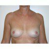 Breast Augmentation 28 Before Photo Thumbnail