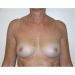 Breast Augmentation 28 Before Photo - 2
