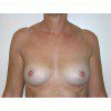 Breast Augmentation 4 Before Photo Thumbnail