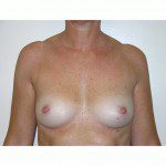 Breast Augmentation 4 Before Photo - 2