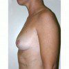Breast Augmentation 4 Before Photo Thumbnail