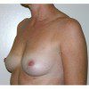 Breast Augmentation 28 Before Photo Thumbnail