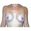 Breast Augmentation 29 After Photo Thumbnail