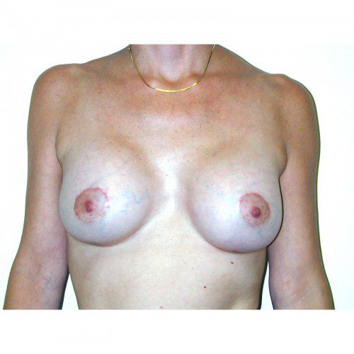 Breast Augmentation 29 After Photo 
