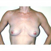 Breast Augmentation 29