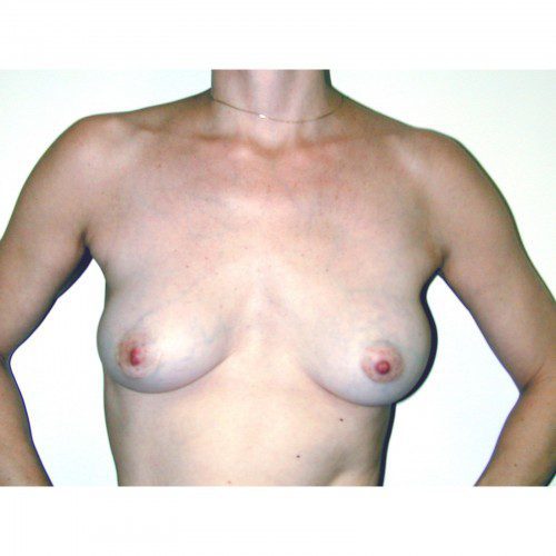 Breast Augmentation 29 Before Photo 