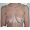 Breast Augmentation 5 Before Photo Thumbnail