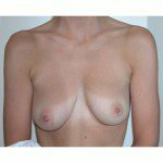 Breast Augmentation 5 Before Photo - 1