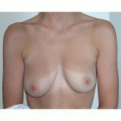 Breast Augmentation 5