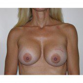 Breast Augmentation 6
