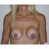 Breast Augmentation 6