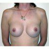 Breast Augmentation 7 After Photo Thumbnail