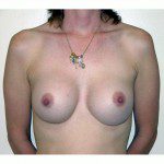 Breast Augmentation 7 After Photo - 11