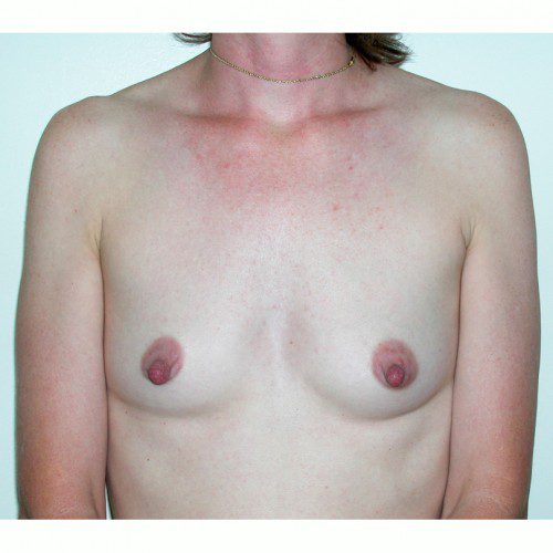 Breast Augmentation 7 Before Photo 